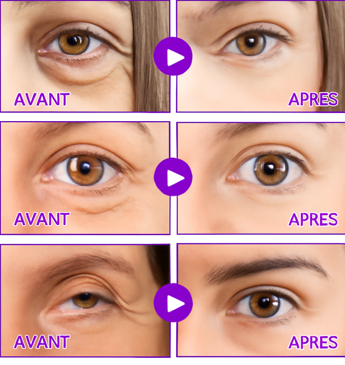 Patch Microneedle Revitalisant Yeux™